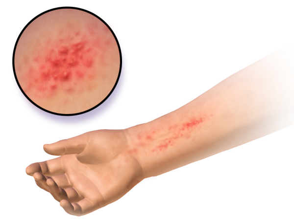traitement allergies peau irritée