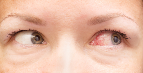 traitement allergies yeux atteints par l’allergie